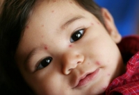 Поширені дерматологічні захворювання у дітей. Інфекції і віруси
