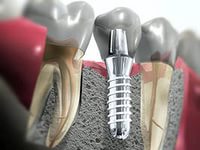 Види зубних імплантатів