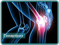 Лікування артрозу колінного суглоба