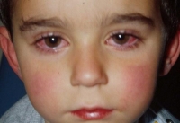 Інфекція хламідіоз у дітей: симптоми, методи лікування