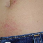 Алергічний дерматит - симптоми, лікування алергічного дерматиту у дітей