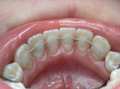 Захворювання пародонту й питання травматичної оклюзії в клініці ортопедичної стоматології