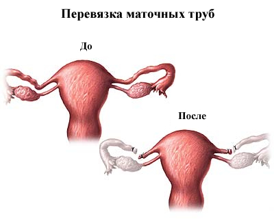 Жіноча і чоловіча стерилізація