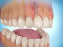 Лазерна імплантація зубів: операція, ціни, відгуки