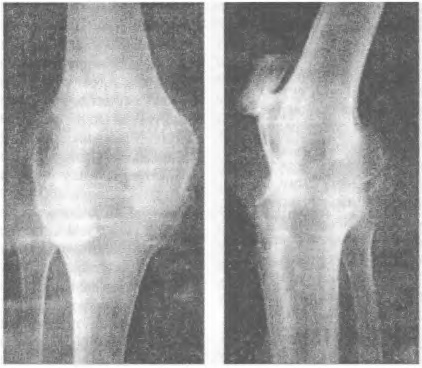 Кістковий анкілоз колінного суглоба: рентгенограма у двох проекціях