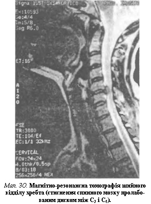 Магнітно-резонансна томографія шийного відділу хребта (стиснення спинного мозку пролабо-ваним диском між С3 і С6)
