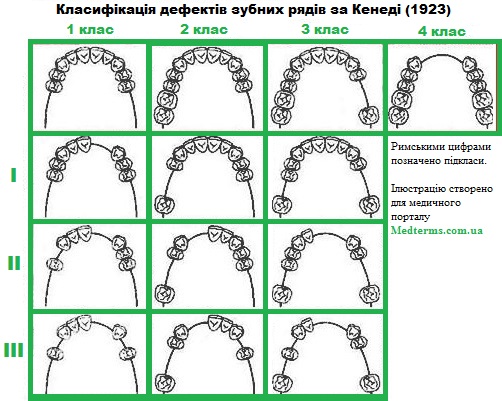 Дефекти зубних рядів. Класифікація за Кенеді Джерело: http://medterms.com.ua/publ/medichni_termini_na_literu_k/klasifikacija_za_kenedi/13-1-0-2389
