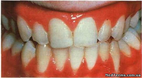 Алергічні захворювання слизової оболонки порожнини рота і губ