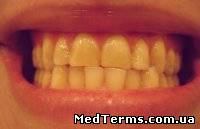 Аномалії зубів у трансверсальному напрямку