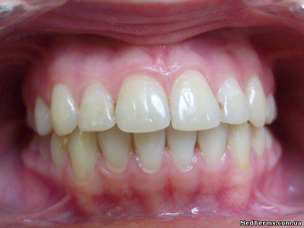 Характер змикання зубних рядів