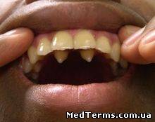 Аномалії кількості зубів