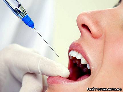 Місцеве знеболювання в стоматології