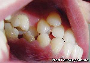 Аномалії положення зубів