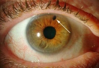 Глаукома: загальні поняття, причини, симптоми