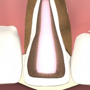 Пломбування кореневих каналів зубів