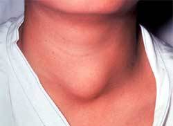 Гіпотиреоз (ослаблення діяльності щитовидної залози)