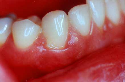 Запалення слизової оболонки рота (стоматит)