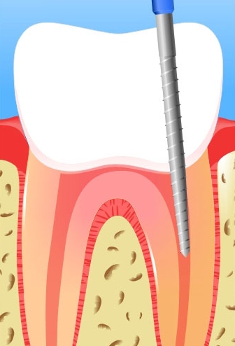 Пульпіт зуба, симптоми і лікування пульпіту