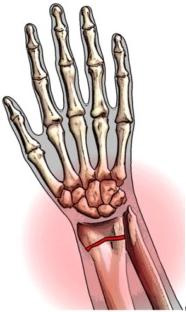 Переломи кісток: симптоми, лікування, ускладнення переломів кісток