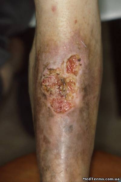 Гнійні захворювання шкіри і підшкірної клітковини