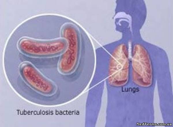 Патоморфоз туберкульозу
