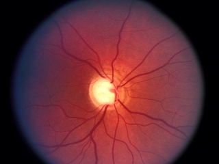 Глаукома, симптоми і лікування глаукоми