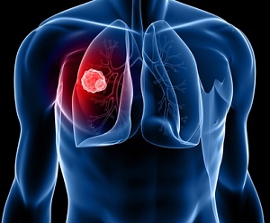 Симптоми і лікування актиномікозу легенів