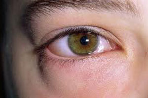 Алергія на очах