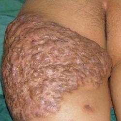 Симптоми і лікування актиномікозу шкіри