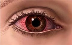 Симптоми і лікування аденовірусної інфекції очей