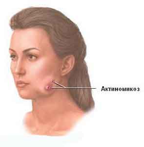 Симптоми і лікування актиномікозу щелепно-лицевої області