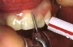Препарування зубів під суцільнолиті металеві коронки