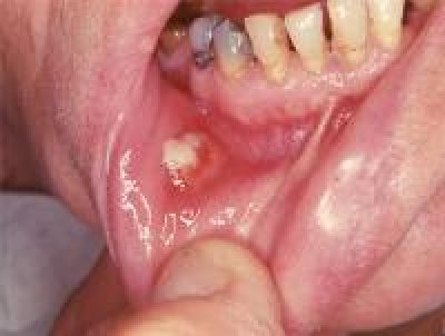 Симптоми і лікування актиномікозу порожнини рота