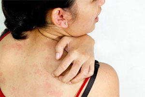 Алергія на шкірі