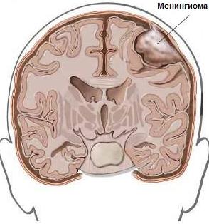 Менінгіома головного мозку