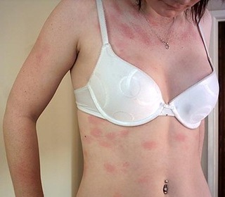 Алергічні шкірні реакції