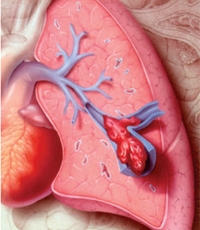 Емболія легеневої артерії