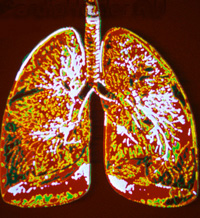 Набряк легенів