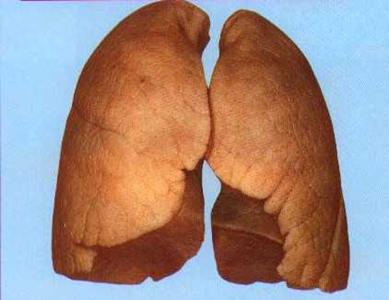 Туберкульоз легенів