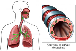Захворювання верхніх дихальних шляхів