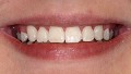 Стоматологічне протезування зубів