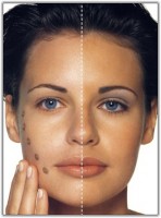 Вирівнювання шкіри обличчя