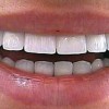 Цирконієві зуби