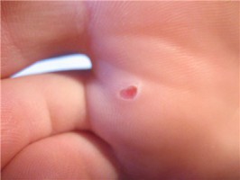 Білі бульбашки на шкірі ніг