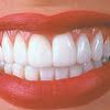 Порцелянові зуби