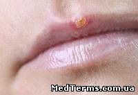 "Застуда" на губах: лікування противірусне, симптоматичне
