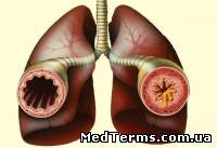 Бронхіальна астма: методи народного лікування