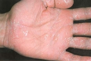 Лущення шкіри рук