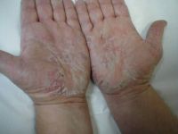 Свербіж і лущення шкіри рук