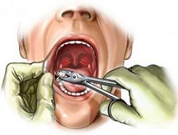 Операція з видалення кісти зуба